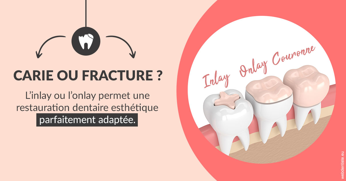 https://dr-mouffok-calle-hourida.chirurgiens-dentistes.fr/T2 2023 - Carie ou fracture 2