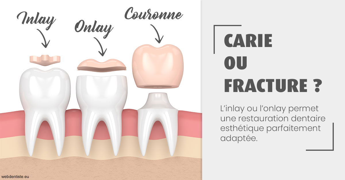 https://dr-mouffok-calle-hourida.chirurgiens-dentistes.fr/T2 2023 - Carie ou fracture 1