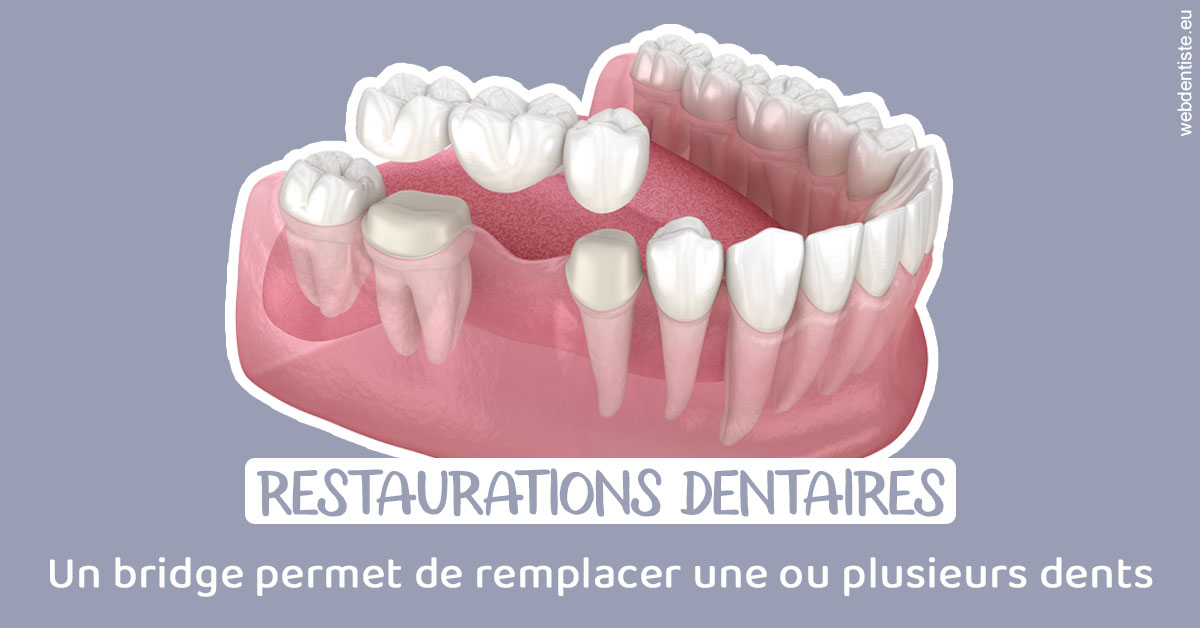 https://dr-mouffok-calle-hourida.chirurgiens-dentistes.fr/Bridge remplacer dents 1