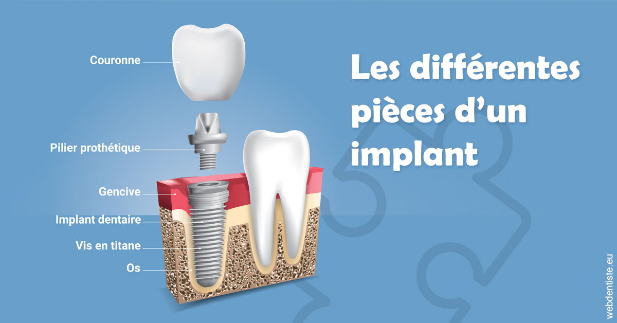 https://dr-mouffok-calle-hourida.chirurgiens-dentistes.fr/Les différentes pièces d’un implant 1