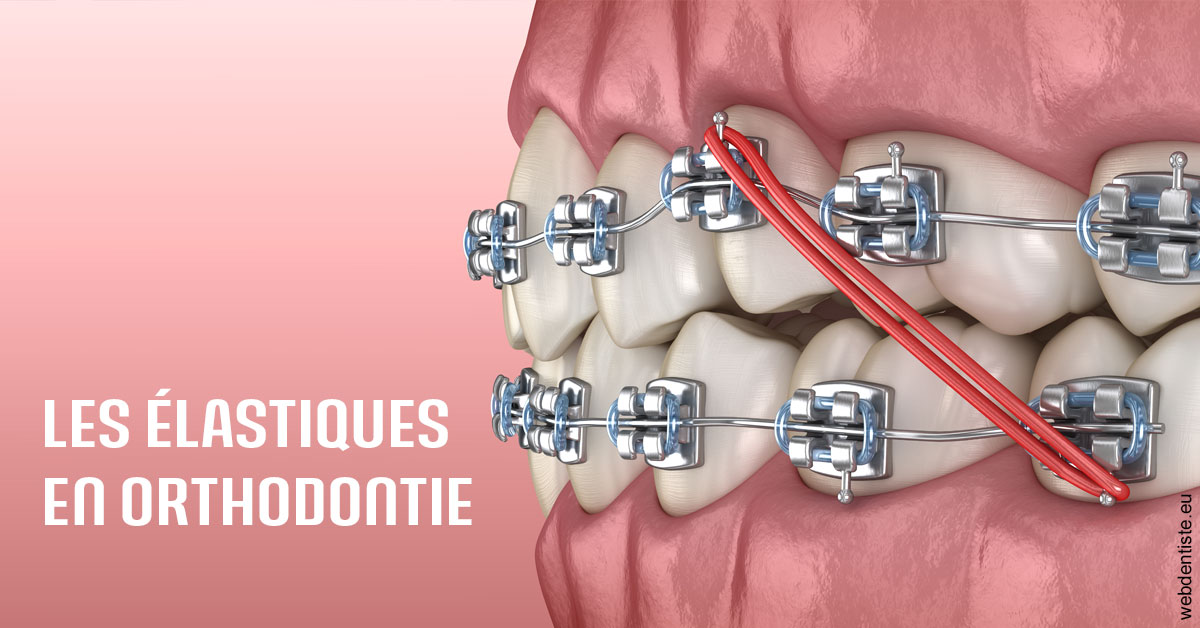 https://dr-mouffok-calle-hourida.chirurgiens-dentistes.fr/Elastiques orthodontie 2